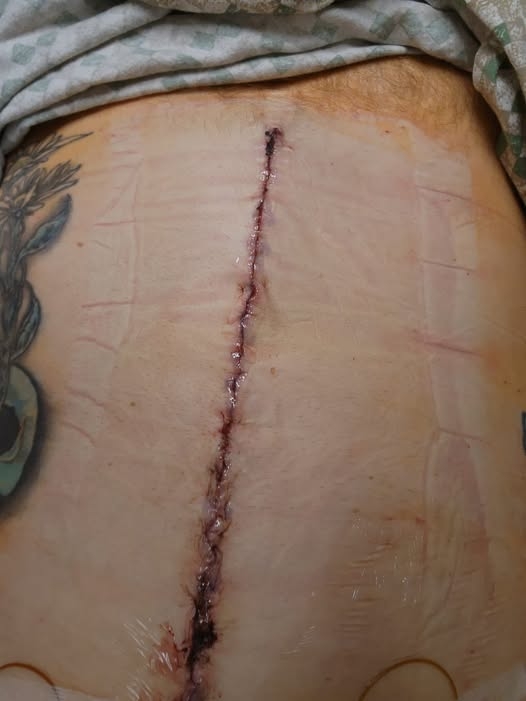 Cyan-E - Belly Button Removal