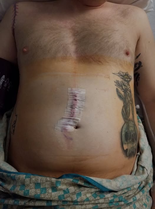 First Hernia Surgery - 1