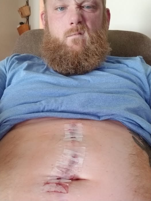 Hernia Surgery - 2