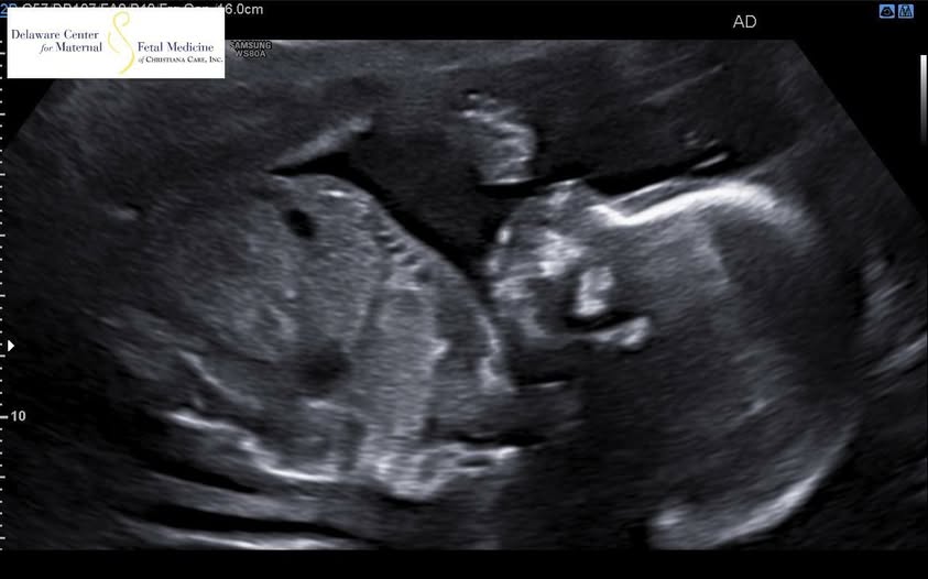 Its A Boy - First Photo of James